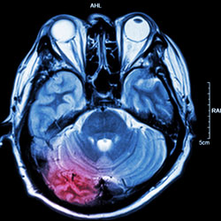 Neuroinflammation im Gehirn